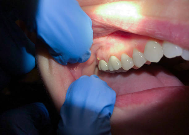 Best Dentist for Severe Toothache  in Clifton Forge, VA